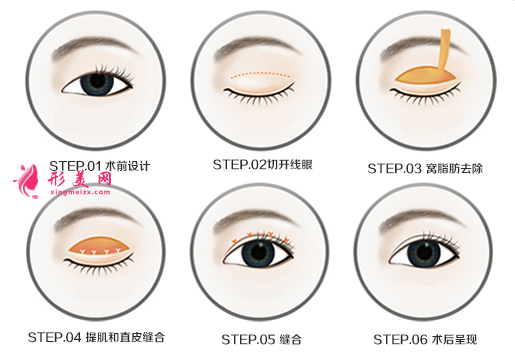 內(nèi)雙并且上眼皮脂肪厚怎么辦