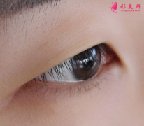 內(nèi)雙并且上眼皮脂肪厚怎么辦？