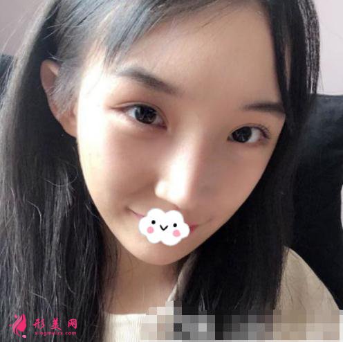 磨顴骨手術術后兩個月