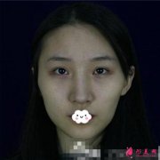 磨顴骨前后對比圖~磨骨手術(shù)能給你帶來的效果須知！