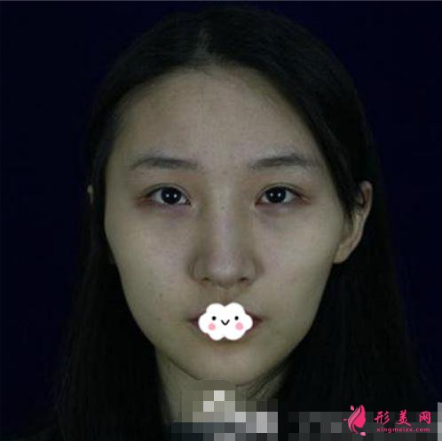 磨顴骨手術術前