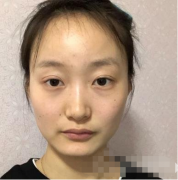 北京藝美王東脂肪填充太陽穴怎么樣？真人案例分享