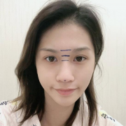 上海百達麗王艷隆鼻怎么樣？隆鼻術后效果，網友親身經歷講述~