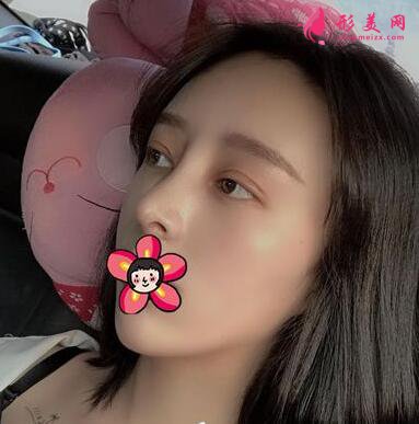 削骨手術(shù)對比圖變化也太大了吧！不信你看！