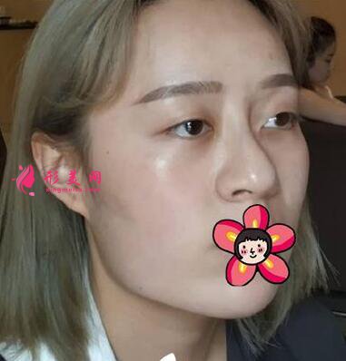削骨手術(shù)對比圖變化也太大了吧！不信你看！