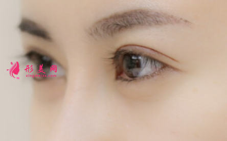 切開(kāi)雙眼皮術(shù)后多久恢復(fù)