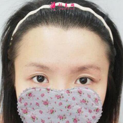 毛發(fā)移植手術效果圖，發(fā)際線種植
