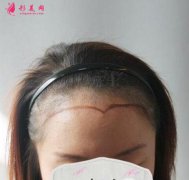 毛發(fā)移植手術(shù)效果圖，發(fā)際線種植