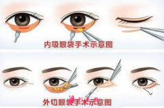 做手術(shù)祛眼袋術(shù)前要做什么準備？