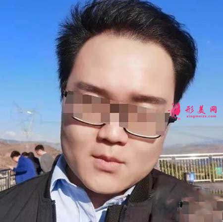 成都雍禾醫(yī)院禿頂4600單位植發(fā)案例