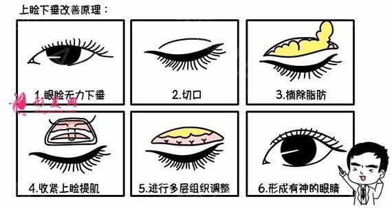 眼綜合淤血怎樣消除