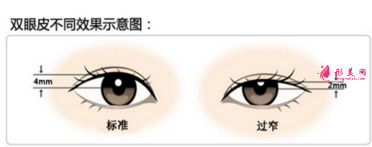 雙眼皮手術怎么修復
