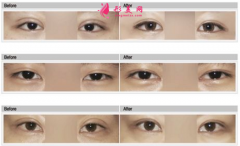 雙眼皮手術(shù)怎么修復(fù)？如何避免手術(shù)失??？