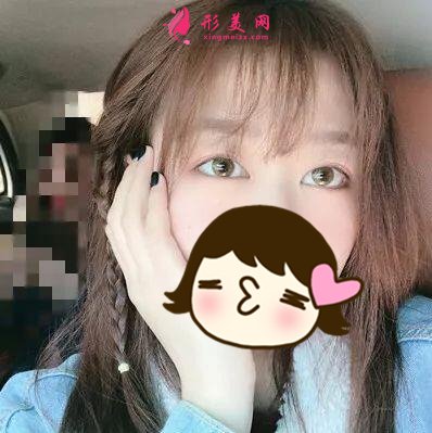 俞翰秀醫(yī)生技術(shù)怎么樣？雙眼皮案例
