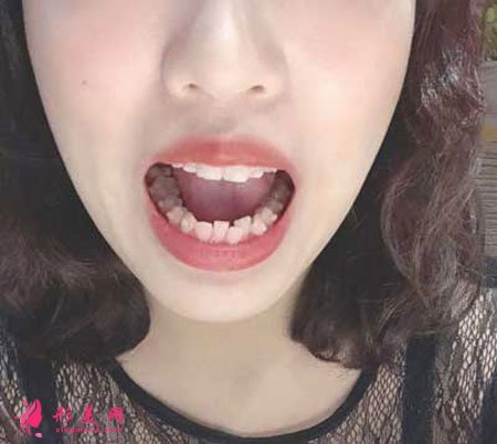 在鄭州天后整形做的隱形矯正，術(shù)后效果特別好！