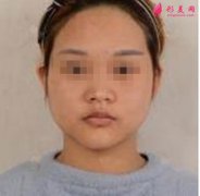 鄭州麗天整形自體軟骨墊鼻尖怎么樣？效果好！小翹鼻好好看！