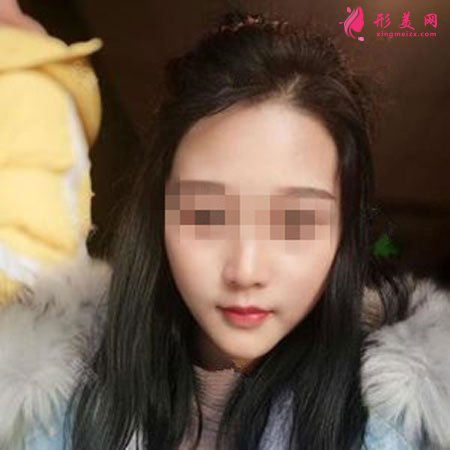 鄭州麗天整形自體軟骨墊鼻尖怎么樣？小翹鼻好好看！