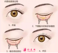 手術(shù)切除眼袋的效果能保持多久？