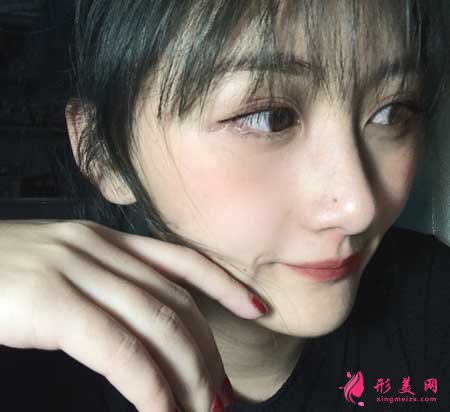 找南京黃金龍醫(yī)生做了隆鼻手術后，鼻子俊俏好看