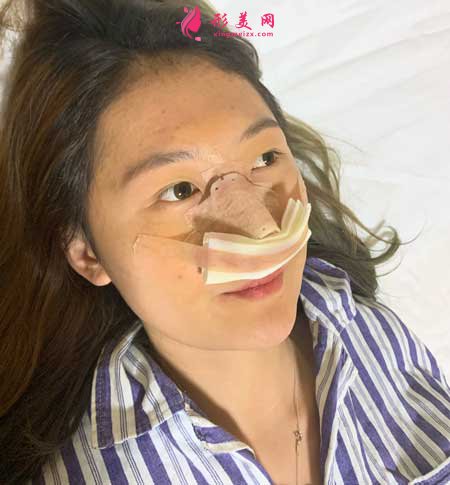 找南京黃金龍醫(yī)生做了隆鼻手術后，鼻子俊俏好看