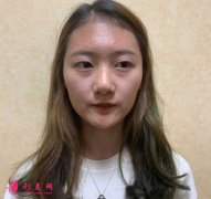 南京黃金龍醫(yī)生做了隆鼻手術(shù)后，鼻子俊俏好看