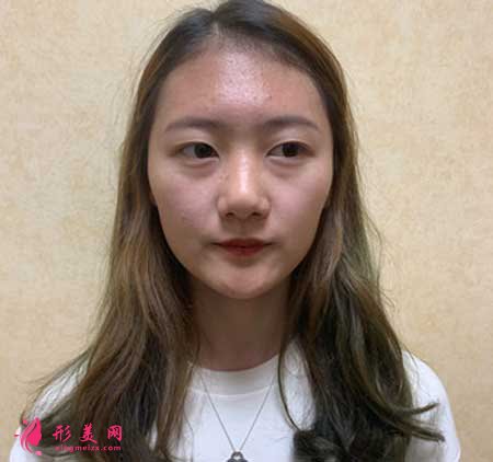 找南京黃金龍醫(yī)生做了隆鼻手術后，鼻子俊俏好看