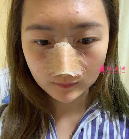 找南京黃金龍醫(yī)生做了隆鼻手術后，鼻子俊俏好看