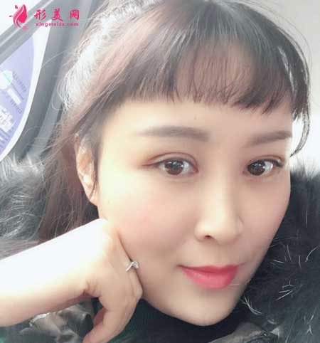 重慶華美整形醫(yī)院的雙眼皮成功案例
