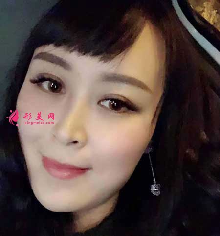 重慶華美整形醫(yī)院的雙眼皮成功案例