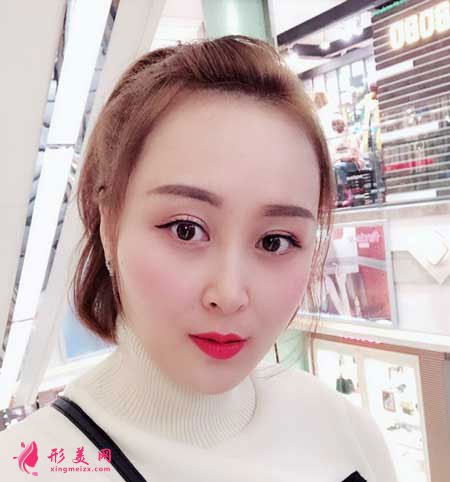 重慶華美整形醫(yī)院的雙眼皮成功案例