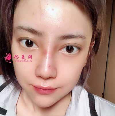 成都軍大整形鼻綜合整形成功案例
