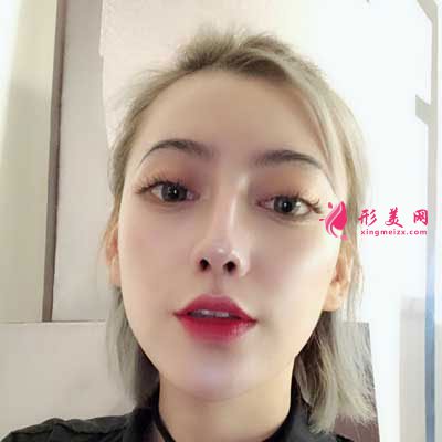 成都軍大整形鼻綜合整形成功案例