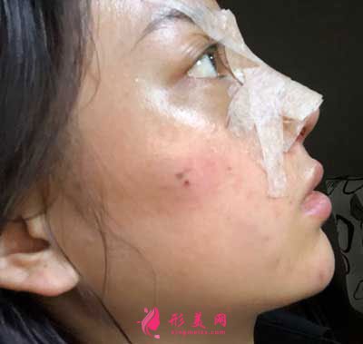 成都軍大整形鼻綜合整形成功案例