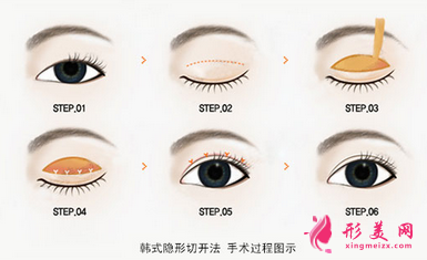 韓式雙眼皮手術(shù)效果