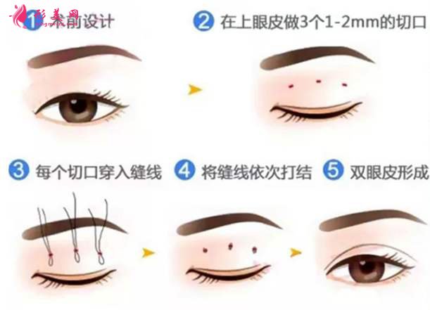 韓式雙眼皮手術(shù)效果