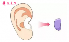 自體軟骨隆鼻價(jià)格是多少？有哪些缺點(diǎn)？