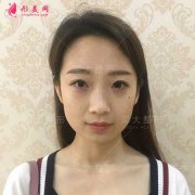成都軍大鐘正強(qiáng)給我做的線雕隆鼻，鼻子特別好看特別精致