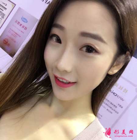 線雕隆鼻術(shù)后30天