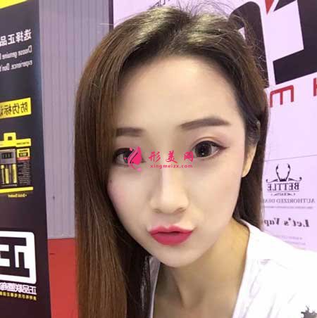 線雕隆鼻術(shù)后50天