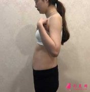 鄭州悅美整形美容醫(yī)院做吸脂瘦腰腹+瘦大腿的親身經(jīng)歷