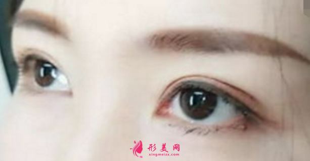 天生雙眼皮還能割雙眼皮嗎