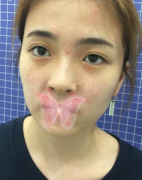 南京美貝爾找黃名斗醫(yī)生做了肋骨鼻，顏值直線提升