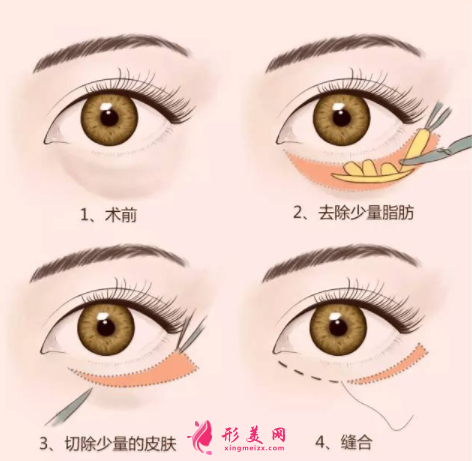 手術(shù)祛除眼袋會(huì)不會(huì)失敗