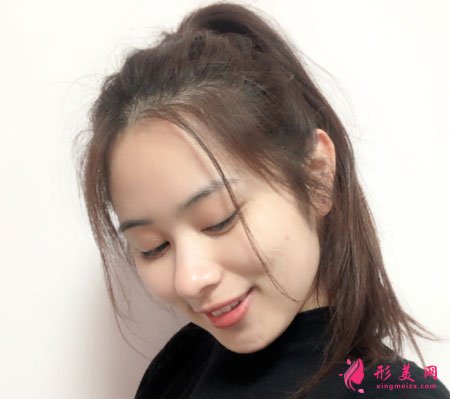 上海玫瑰醫(yī)療美容醫(yī)院的眼部多項(xiàng)整形的案例