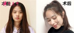 上海玫瑰醫(yī)療美容醫(yī)院的眼部多項整形怎么樣？案例前后對比