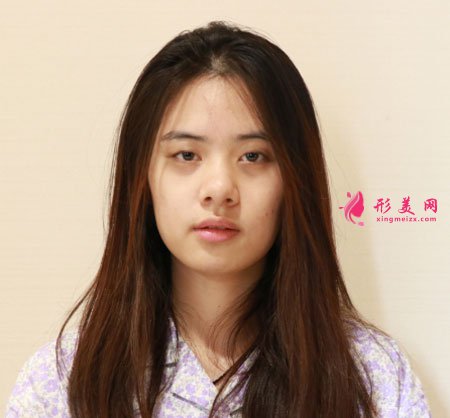 上海玫瑰醫(yī)療美容醫(yī)院的眼部多項(xiàng)整形的案例