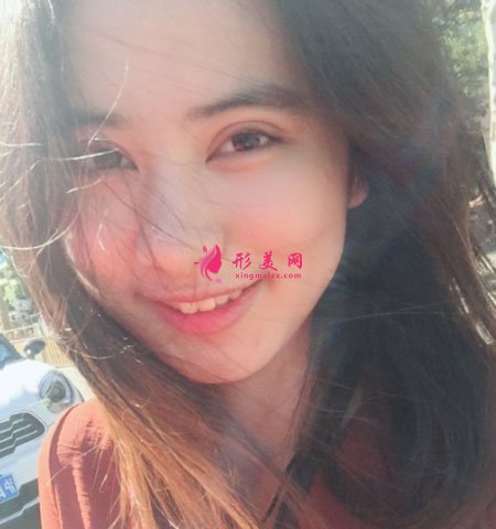 上海玫瑰醫(yī)療美容醫(yī)院的眼部多項(xiàng)整形的案例