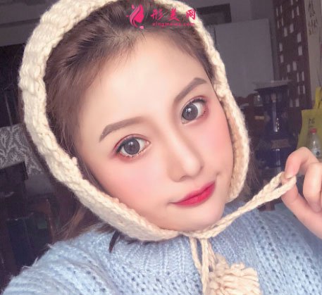 杭州麗脂醫(yī)療美容醫(yī)院的面部吸脂案例