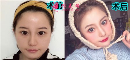 杭州麗脂醫(yī)療美容醫(yī)院的面部吸脂案例對比圖