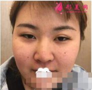 北京八大處整形做的面部吸脂怎么樣？術(shù)后顏值直線上升！